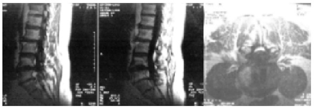  MRI performed three years after operation of segment L4/5 using a pair of glass-ceramic implants (1998). 