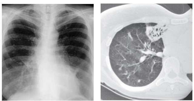  In a comparison of a frontal chest radiograph with a CT scan of a patient with hemoptysis, the radiograph (left) suggests only an infiltrate in the right middle lobe; the CT scan (right) shows bronchiectasis in the right middle lobe that was the source of the bleeding.