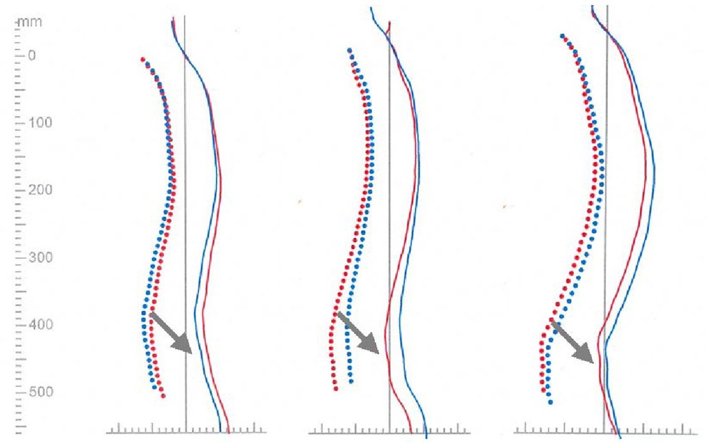 Spinal alignment of three low back pain patients with different types of spine shape suffering from lumbar facet syndrome in repeated measurements (back surface [drawn] and calculated vertebral centres [dotted] before [red] and after [blue] treatment) with signals for structural changes of vertebral elements [arrows] 