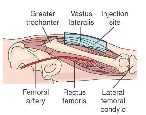 Vastus lateralis injection site. 