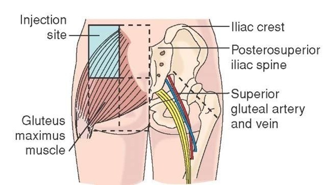 Dorsogluteal injection site. 