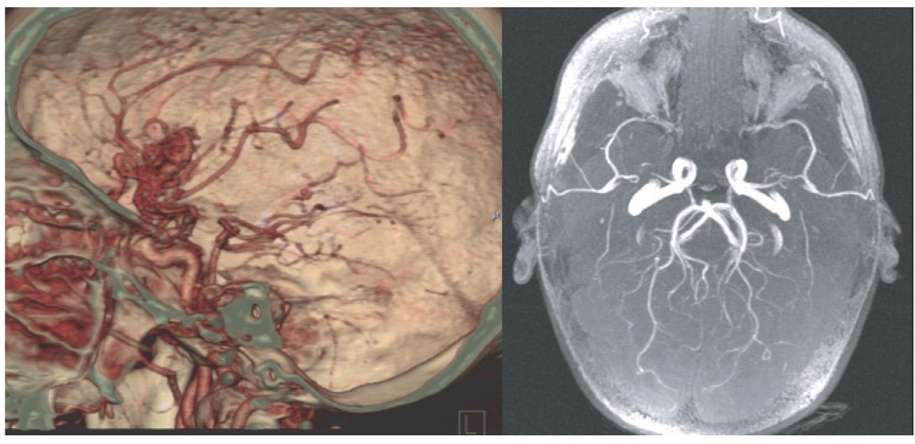  CTand magnetic resonance angiography (MRA). The image in the left panel is from the same patient as shown in Fig. 10.10 and demonstrates the arteriovenous malformation within the region of the right Sylvian fissure. Further investigation using formal angiography was undertaken to delineate the arterial supply and venous drainage of the lesion. The image in the right panel was obtained using MRA and demonstrates a normal-appearing cerebral circulation. 