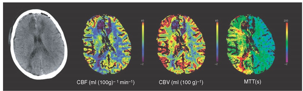 Assessment of cerebral blood flow (CBF) using CT perfusion. This patient suffered a subarachnoid haemorrhage secondary to an anterior communicating artery aneurysm. The plain CT image on the left demonstrates hypodensity within the medial aspects of the frontal cortex in both hemispheres and also within the right occipital cortex. These areas have very low CBF and cerebral blood volume (CBV) suggestive of established infarction. In addition, there is a generalized reduction in CBF across the right hemisphere with an increase in CBV suggestive of cerebral ischaemia secondary to arterial vasospasm. This reduction of perfusion is most noticeable on the mean transit time (MTT) image, which clearly shows the delay in perfusion across the whole right hemisphere. 