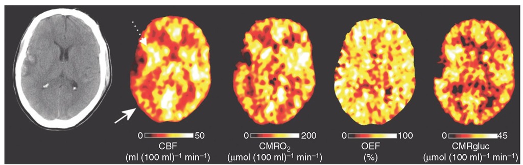 Positron emission tomography (PET) imaging of regional metabolism following head injury. X-ray CT, PET cerebral blood flow (CBF), oxygen metabolism (CMRO2), oxygen extraction fraction (OEF) and glucose metabolism (CMRglu) images obtained following early head injury. Note the right temporal haemorrhagic contusion with surrounding rim of hypodensity on the X-ray CT. The lesion core reflects infarcted brain with no or very low CBF. The pericontusional cerebral hemisphere displays variable pathophysiology. Immediately adjacent to the lesion core (dotted arrow), CBF is increased, CMRO2 and OEF variable but glucose metabolism increased, while the right parietal occipital cortex (white arrow) demonstrates a decrease in CBF and CMRO2 with an increase in OEF and variable glucose metabolism suggestive of regional cerebral ischaemia. The increase in CMRglu implies a switch to non-oxidative metabolism of glucose in order to meet underlying metabolic needs. 