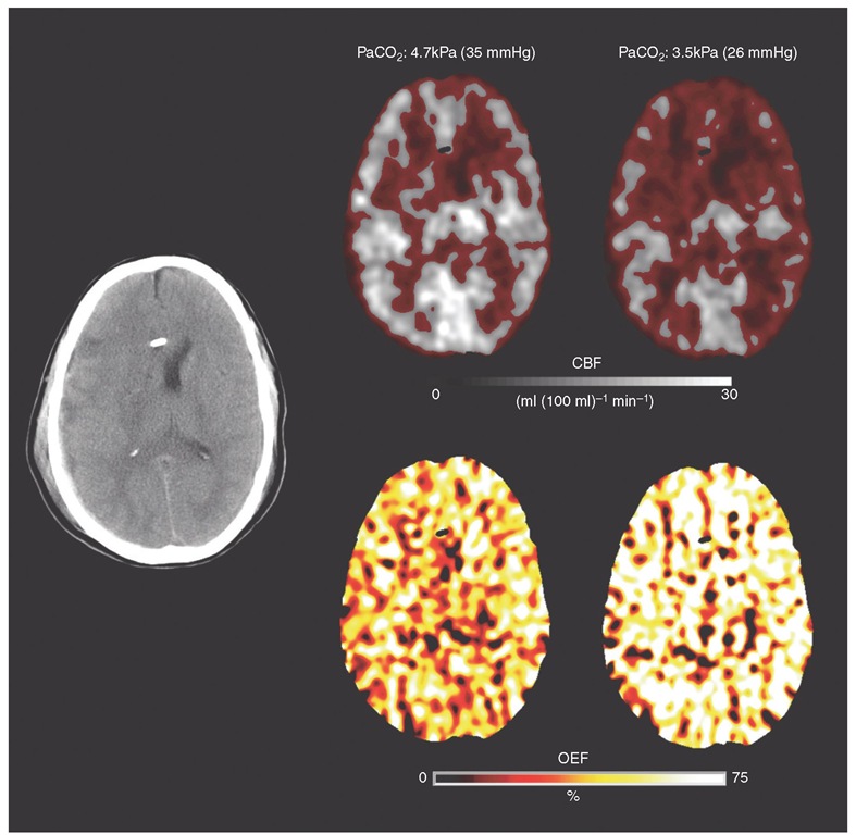 Assessment of the efficacy of acute hyperventilation using positron emission tomography (PET) imaging. Structural CT following early head injury demonstrates a thin right subdural haematoma with underlying cerebral contusion, swollen hemisphere with effacement of the ipsilateral ventricle and midline shift. Greyscale PET cerebral blood flow (CBF) images were obtained at relative normocapnia (left panel) and hypocapnia (right panel). Voxels with a CBF <15 ml (100 ml)-1 min-1 are picked out in red. Baseline intracranial pressure (ICP) was 21 mmHg and supports the use of hyperventilation to lower arterial carbon dioxide tension (PaCO2) and improve ICP control. Hyperventilation did result in a reduction in ICP to 17 mmHg, but, in this individual, led to a substantial increase in the volume of hypoperfused brain. The PET oxygen extraction fraction (OEF) images show that the effect of the reduction in perfusion is a dramatic increase in OEF to levels consistent with cerebral ischaemia. 