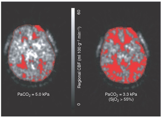 Positron emission tomography imaging showing the effect of hyperventilation in the first 24 h following TBI on regional CBF. Even with an acceptable SjO2, hyperventilation results in a marked increase in the volume of brain tissue (highlighted areas) below an ischaemic threshold (20 ml (100 g)-1 min-1) due to vasoconstriction from hypocapnia. 