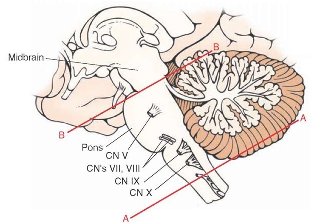Experimental transection of the brainstem. Lateral view of the brainstem showing two levels of transection: (line A) near spinal cord-medulla juncture (encephale isole); and (line B) upper pons, rostral to the trigeminal nerve (cerveau isole). An alert cortical electroencephalo-graphic pattern characteristic of a beta rhythm can still be obtained after a cut shown in "A" but not in "B" because, after a transection of the spinal cord-medulla border, sensory information from cranial nerves is preserved, whereas this is not the case after a high pontine transection. CN = cranial nerve.