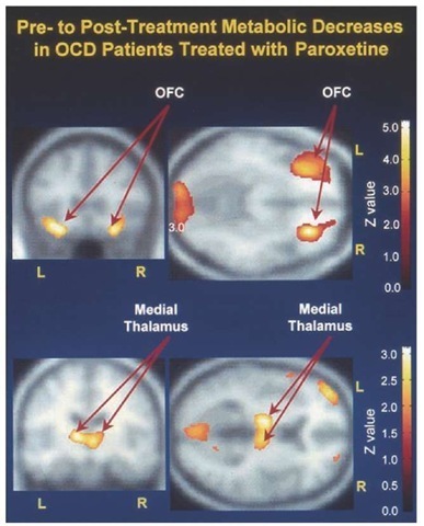 Fluorodeoxyglucose positron emission tomography scans of representative patients in the horizontal plane at a mid level of the caudate nucleus before and after successful drug treatment of obsessive-compulsive disorder (OCD). Scans are processed to reflect the ratio of glucose metabolic rate registered by each pixel element, divided by that of the whole brain. OFC =orbital frontal cortex; L = left; R = right.