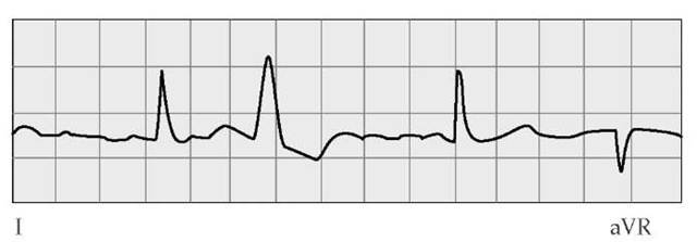 An electrocardiographic tracing shows characteristic features of atrial fibrillation, with absent P waves, irregular fibrillatory waves, and an irregularly irregular ventricular response.