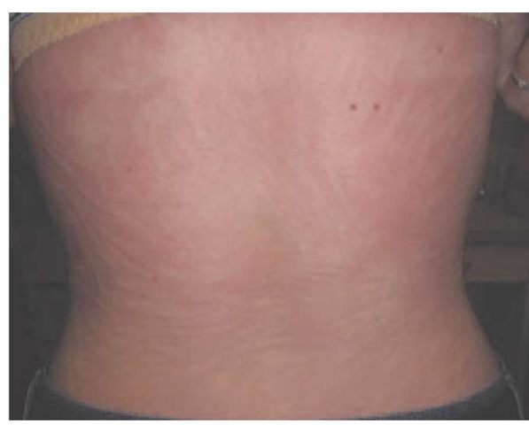  Multiple linear, erythematous wheals secondary to scratching are noted on the back of a patient with chronic urticaria and dermatographism.