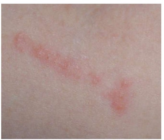 What is Scabies? | Rash Symptoms, Test and Treatment