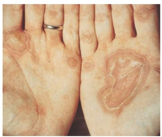 Target lesions are characteristic of erythema multiforme.
