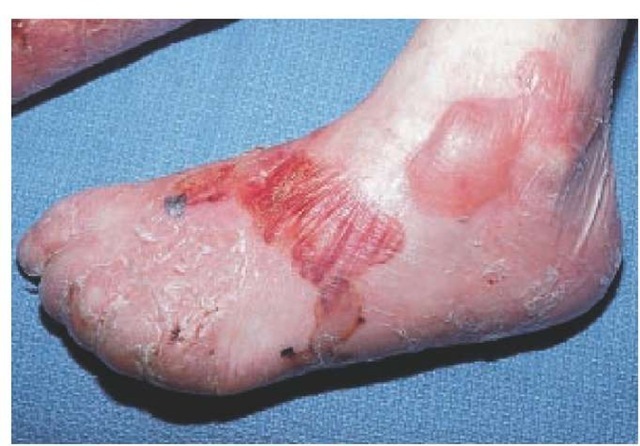 Recessive dystrophic epidermolysis bullosa may cause severe scarring and syndactyly.