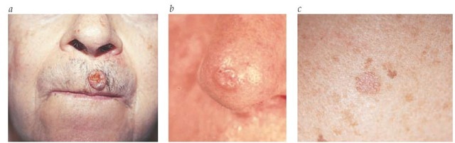  Nodular basal cell carcinoma—shown here above a patient's lip, with a so-called rodent's ulcer (a)—commonly presents as a raised, pearly, translucent pink bump on the skin surface (b). A superficial form appears as a pink patch of skin (c).