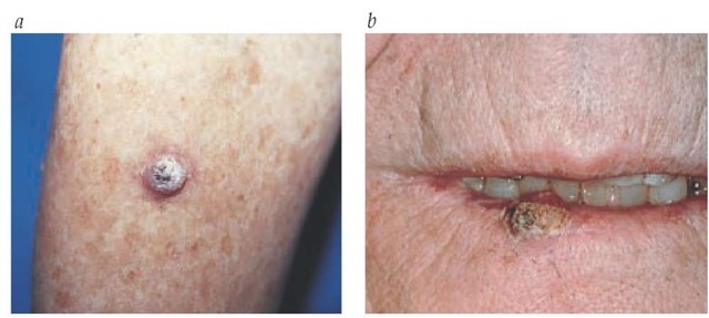 A squamous cell carcinoma is shown on an arm (a) and lower lip (b).