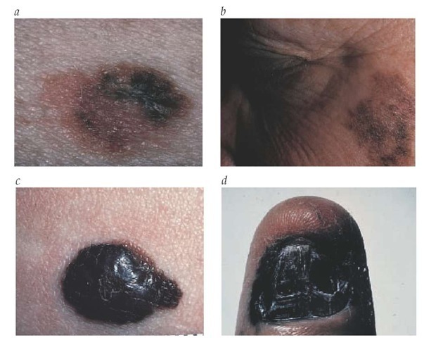 Superficial spreading malignant melanoma begins as a small, irregular brown lesion (a). Variation in color and contour is characteristic of lentigo maligna melanoma (b). Nodular melanoma often grows more in thickness than in diameter (c). Acral lentiginous melanoma can resemble a hematoma under the nail (d).