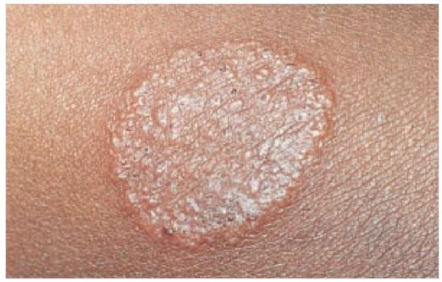 Classic annular lesion of tinea corporis shows a raised or vesicular margin with central clearing.