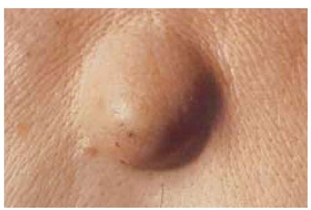 This large epidermoid cyst has a central pore, contains thick keratinous material, and has a lining that resembles the epidermis.