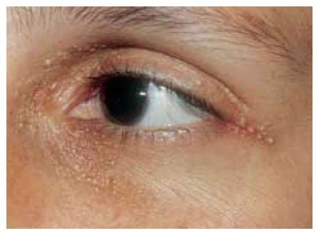  Milia, which are multiple small subepidermal inclusion cysts, can be observed in the periorbital area of this patient.