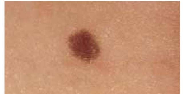A flat junctional nevus with dark pigmentation is seen in this patient.