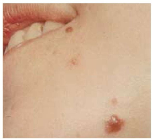 This slightly raised compound nevus typically has less pigmentation than a junctional nevus.