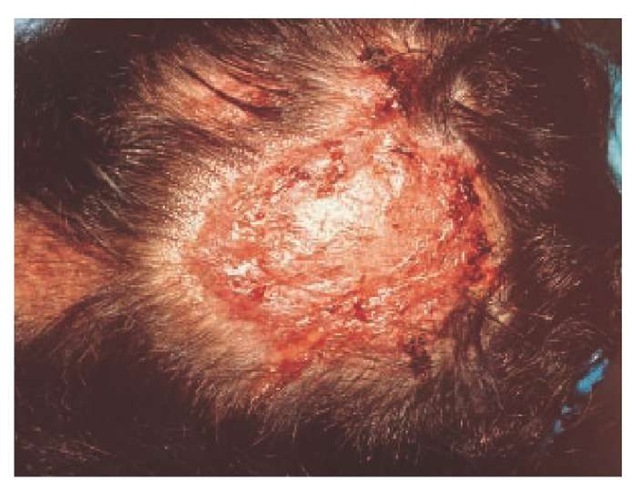 A typical kerion presenting as a zoophilic Microsporum canis infection of the scalp (tinea capitis). 