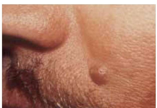 A skin-colored intradermal nevus with a dome-shaped configuration is seen on the face.