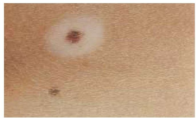 The halo nevus may represent an autoimmune phenomenon; a zone of hypopigmentation may appear around a nevus, with subsequent involution of the pigmented tumor.
