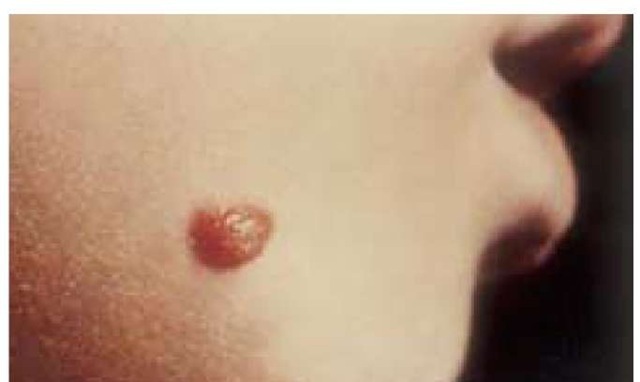 The spindle cell nevus is an active compound nevus that may be difficult to distinguish histologically from a melanoma.
