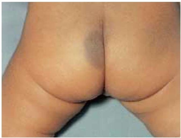The bluish pigmentation of a mongolian spot is seen in the lumbosacral area and is caused by the persistence of dermal melanocytes.