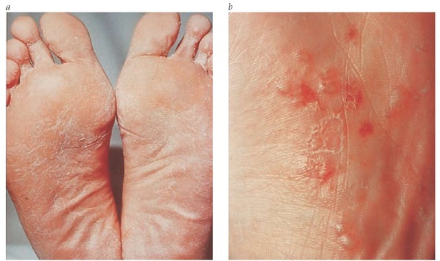  (a) The scaling of tinea pedis appears between and under the toes and on the plantar surface. (b) Tinea pedis may also present as vesicles. 