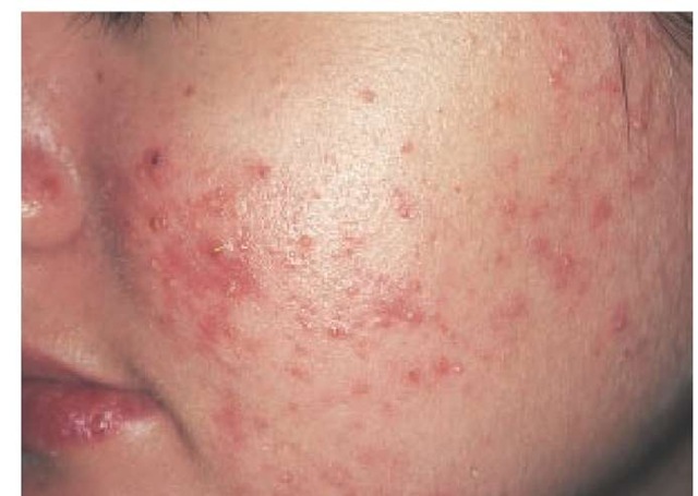 Inflammatory acne is characterized by erythematous papules and pustules.
