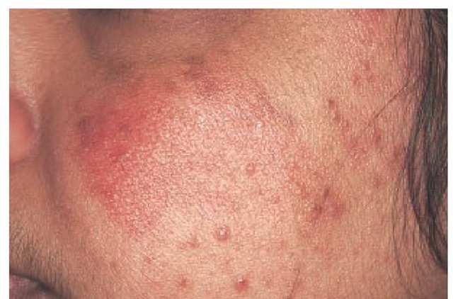 Erythematous papules, pustules, telangiectasia, and flushing are features of rosacea.