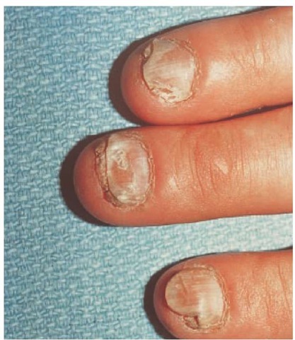 Nails are usually thickened, cracked, and crumbly in tinea unguium; subungual debris may be present, as shown.  
