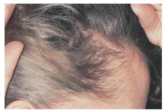 Telogen Effluvium Hair Loss - American Osteopathic College ...