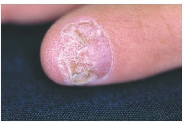 Psoriasis of the nail, characterized by subungual hyperkeratosis and loss of distal onycholytic nail plate. This patient was unsuccessfully treated with oral antifungal therapy after an erroneous diagnosis of onychomycosis was made on the basis of clinical diagnosis alone. Careful examination of the proximal intact nail plate reveals pitting, a feature characteristic for psoriasis and not onychomycosis.