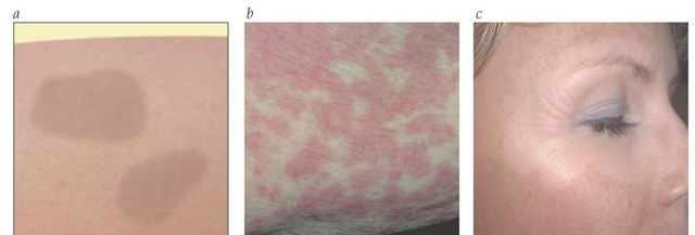  (a) Schematic drawing of macules (lesions < 0.5 cm) or patches (lesions > 0.5 cm). Macules and patches are flat areas of skin for which the color and texture differ from that of the surrounding tissue. (b) Nonblanching erythematous macules and patches are present in a patient with a drug eruption. (c) Depigmented macules are noted on the face of a patient with vitiligo.