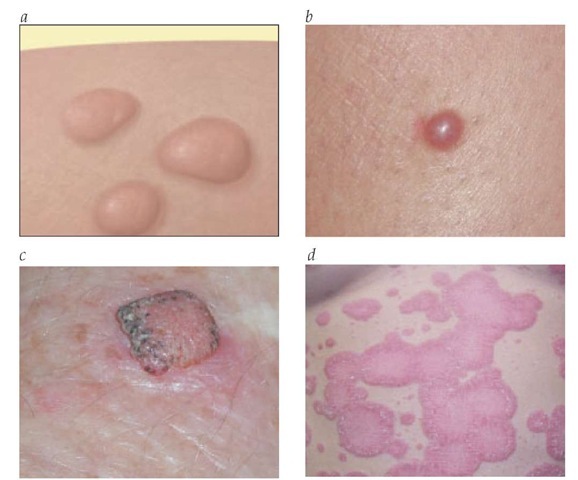 (a) Schematic drawing of papules (lesions < 0.5 cm) or nodules (lesions > 0.5 cm). Papules and nodules are discrete, solid, elevated lesions. (b) A raised, dome-shaped, erythematous papule is seen in a case of dermatofibroma. (c) A raised, flat-topped, erythematous, and hyperkeratotic nodule with scalloped edges is present in a patient with squamous cell carcinoma. (d) Large, erythematous plaques of psoriasis have an annular appearance, owing to their elevated margins.