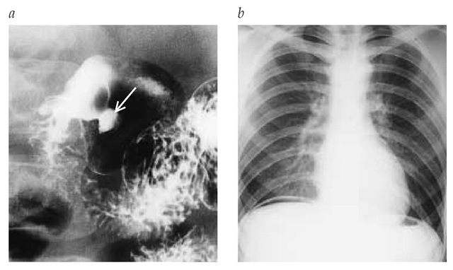 (a) Upper GI series in which double contrast (barium and air) is used, showing rounded collection of barium in an ulcer (arrow) in the duodenal bulb of a patient presenting with dyspepsia (uncomplicated duodenal ulcer). (b) Upright chest x-ray showing air beneath the right hemidiaphragm (pneumoperitoneum) of a patient presenting with an acute abdomen caused by a perforated duodenal ulcer. 