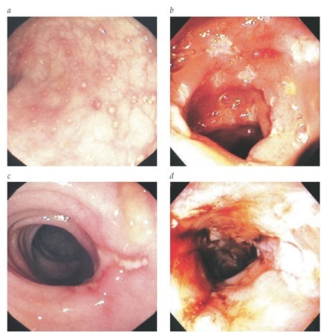 Endoscopic spectrum of Crohn disease includes (a) aphthous ulcerations amid normal colonic mucosal vasculature; (b) deeper, punched-out ulcers in ileal mucosa; (c) a single colonic linear ulcer; and (d) deep colonic ulcerations forming a stricture. 
