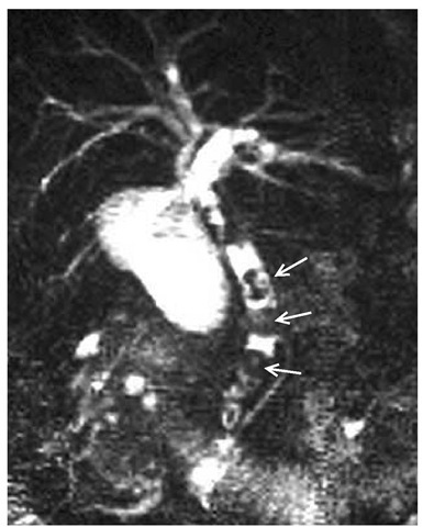 This magnetic resonance cholangiopancreatogram shows multiple gallstones (arrows) in the common bile duct (choledocholithiasis).   