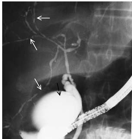 This cholangiogram, obtained during endoscopic retrograde cholangiopancreatography, shows a normal gallbladder (black arrow) and a narrowed biliary tree with many areas of segmental stenosis (white arrows), diagnostic of primary sclerosing cholangitis. 