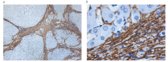 Immunohistochemical analysis of accumulation of fibrogenic myofibroblasts (smooth muscle [a-actin-positive] cells) in a liver biopsy specimen from a 56-year-old man with liver cirrhosis from chronic hepatitis C infection. The patient was admitted for the study of new-onset ascites. Myofibroblasts mainly accumulate in fibrous septa. Some activated hepatic stellate cells can be observed around hepatic sinusoids (arrow). (a) Magnification: x40; (b) magnification: x600.