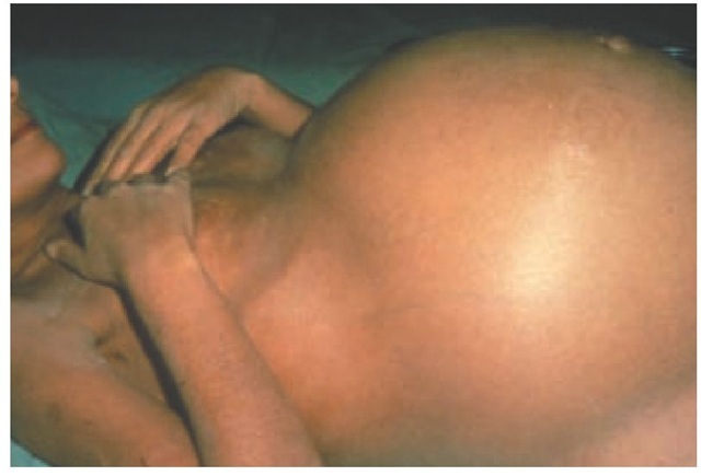 Photograph of a 45-year-old patient with advanced cirrhosis from alcohol-induced liver disease. The patient was admitted because of tense ascites, and a superimposed acute alcoholic hepatitis was diagnosed. A large-volume paracentesis followed by albumin administration was performed.