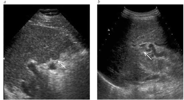 Real-time ultrasound images of a 56-year-old man with liver cirrhosis from chronic hepatitis C. The patient had a compensated cirrhosis and was undergoing liver ultrasonography plus determination of a-fetoprotein serum levels every 6 months to screen for hepatocellular carcinoma. (a) The liver showed irregular edges (arrow) and an altered structure. (b) A patent portal vein thrombosis was detected (arrow).