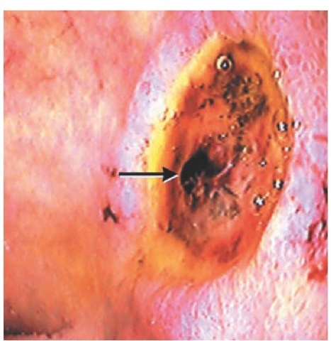 High-risk posterior duodenal bulb ulcer with nonbleeding visible vessel (arrow).