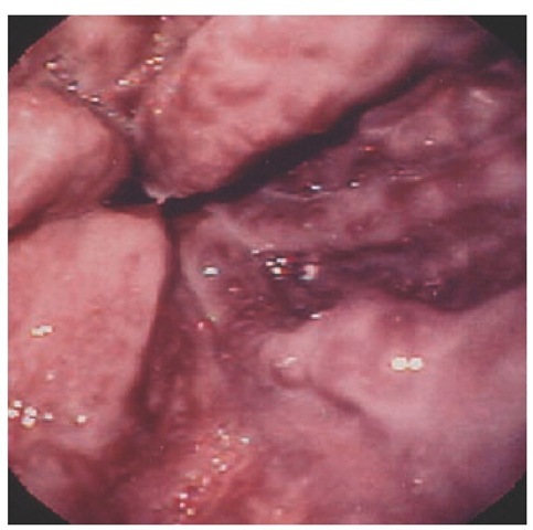 High-risk esophageal varices with red wale marking.