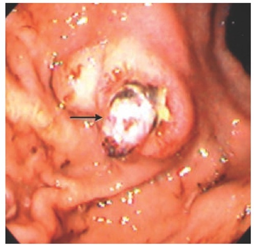 Dieulafoy lesion in gastric fundus (arrow).