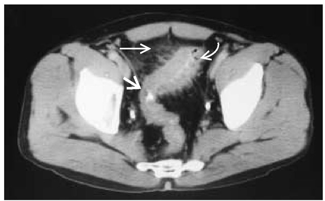  CT diverticulitis. The wall of the sigmoid colon is thickened (broad arrow). Air is seen within a diverticulum (curved arrow). Streaky enhancement of pericolis fat (horizontal arrow) is caused by inflammation.