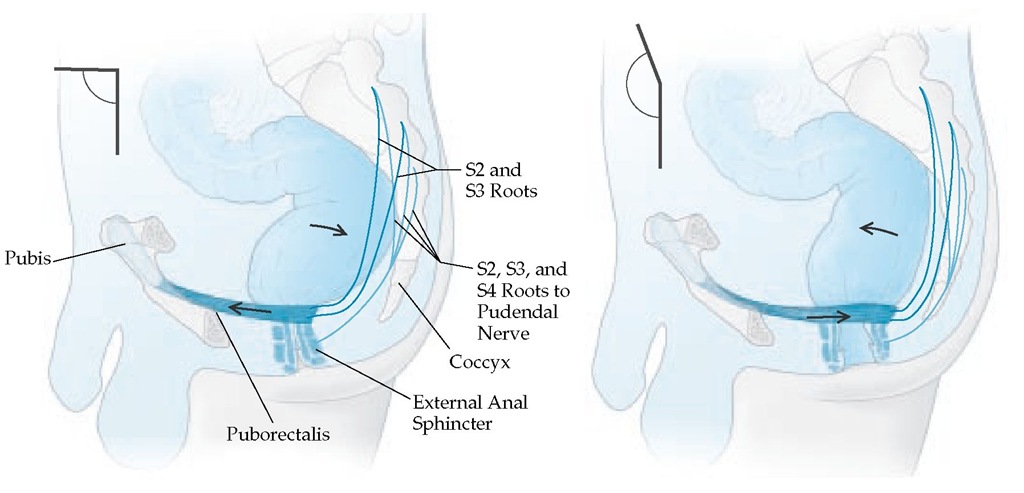 Normal defecation requires relaxation of the puborectalis and external anal sphincter, straightening of the rectoanal angle, and an increase in intraluminal pressure, usually induced by the Valsalva maneuver. Defecation may be obstructed if any of these functions is impaired.
